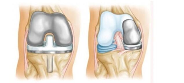 artroplastia para la artrosis de la articulación de la rodilla