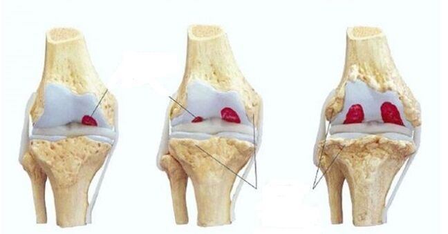 etapas de la artrosis de la articulación de la rodilla