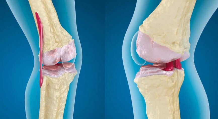 articulación sana y artrosis de la articulación de la rodilla