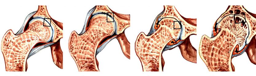 El grado de desarrollo de la artrosis de la articulación de la cadera. 