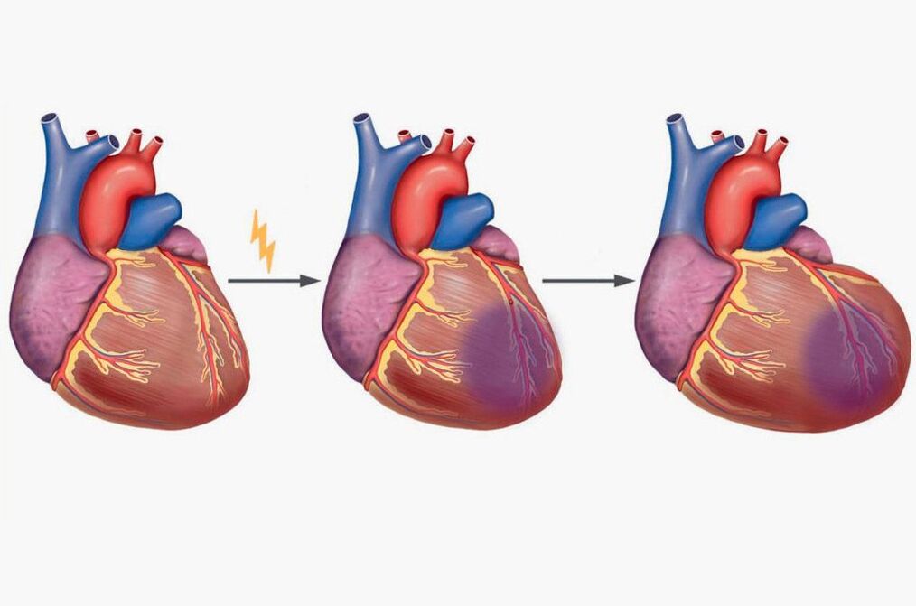 El infarto de miocardio provoca dolor en los omóplatos. 
