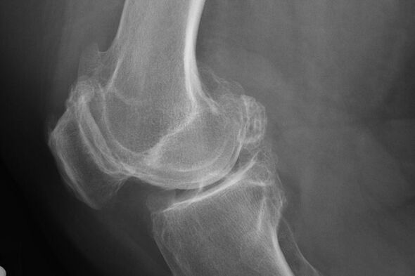 Métodos para diagnosticar la artrosis de la rodilla