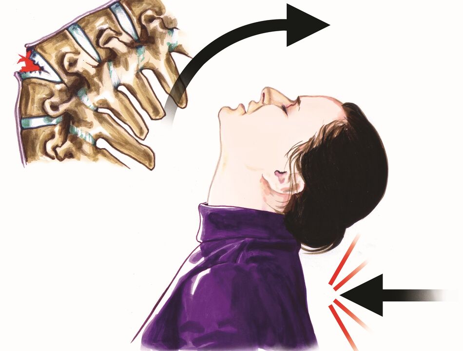 Daño espinal como causa de dolor de cuello.