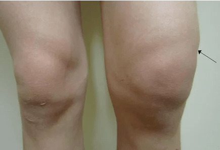 Hemartrosis de la articulación de la rodilla.
